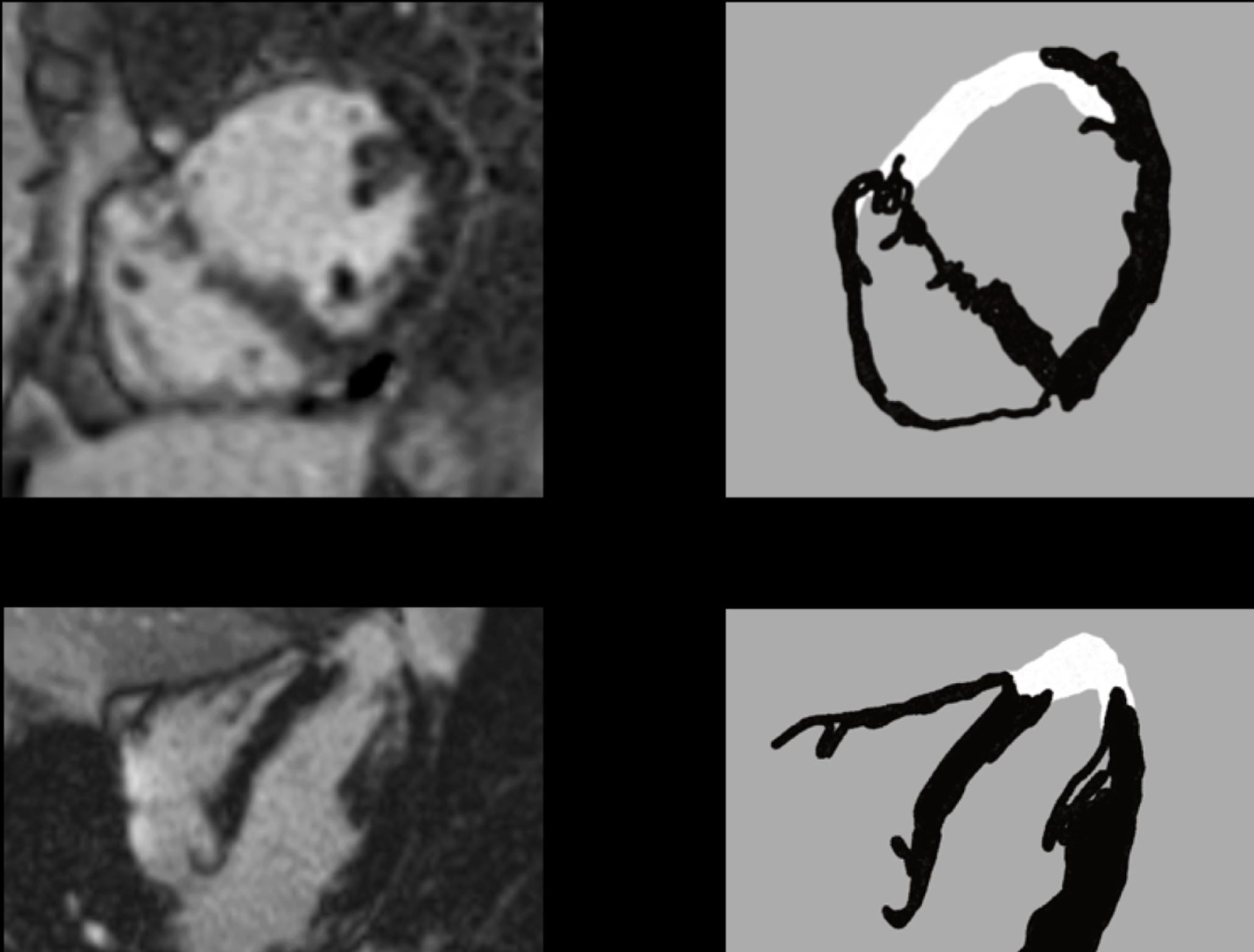 Spectrum of late gadolinium enhancement patterns in cardiac magnetic resonance imaging
